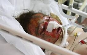 مرگ و میر سالیانه 3600 ایرانی به علت سوختگی