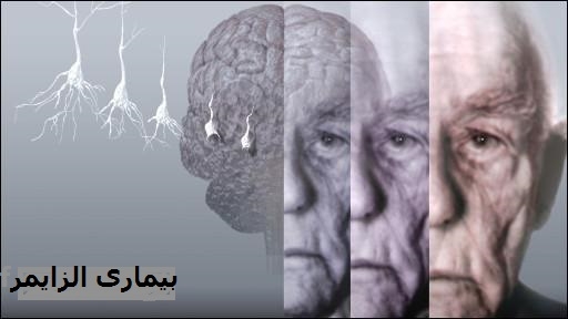اسکن ام آر آی برای شناسایی آلزایمر